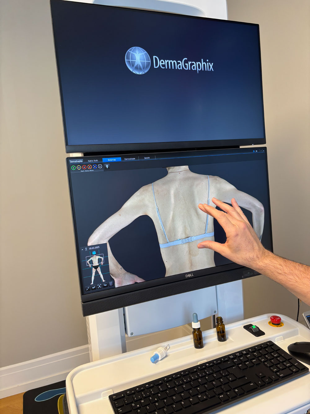 Der Vectra 360° gilt als das fortschrittlichste Hautscreening-Gerät und als beste Präventionsmassnahme gegen Hautkrebs. Doch wie gut ist es wirklich? Mein Selbsttest auf sonrisa verrät es.