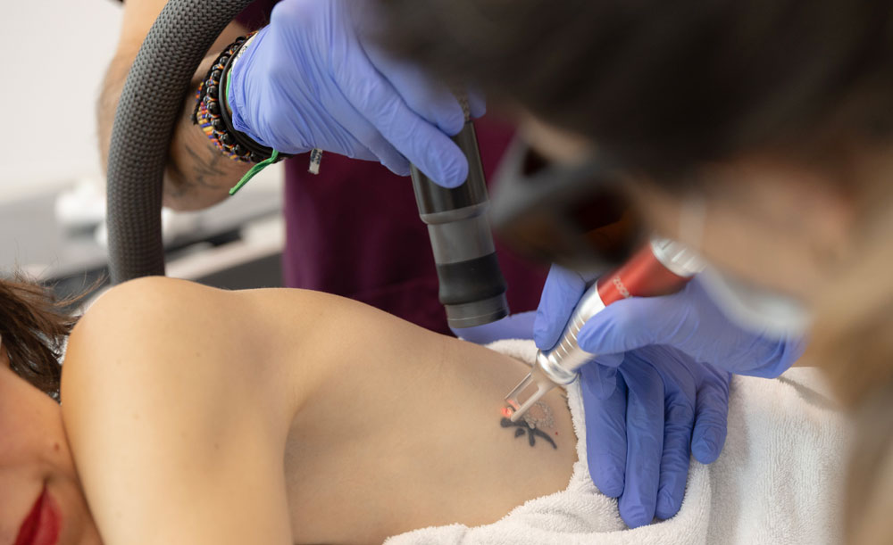 Mein Jugend-Tattoo aus 2000 muss weg. Auf sonrisa erfährst du, wie die Entfernung per Pico-Laser wirklich läuft.