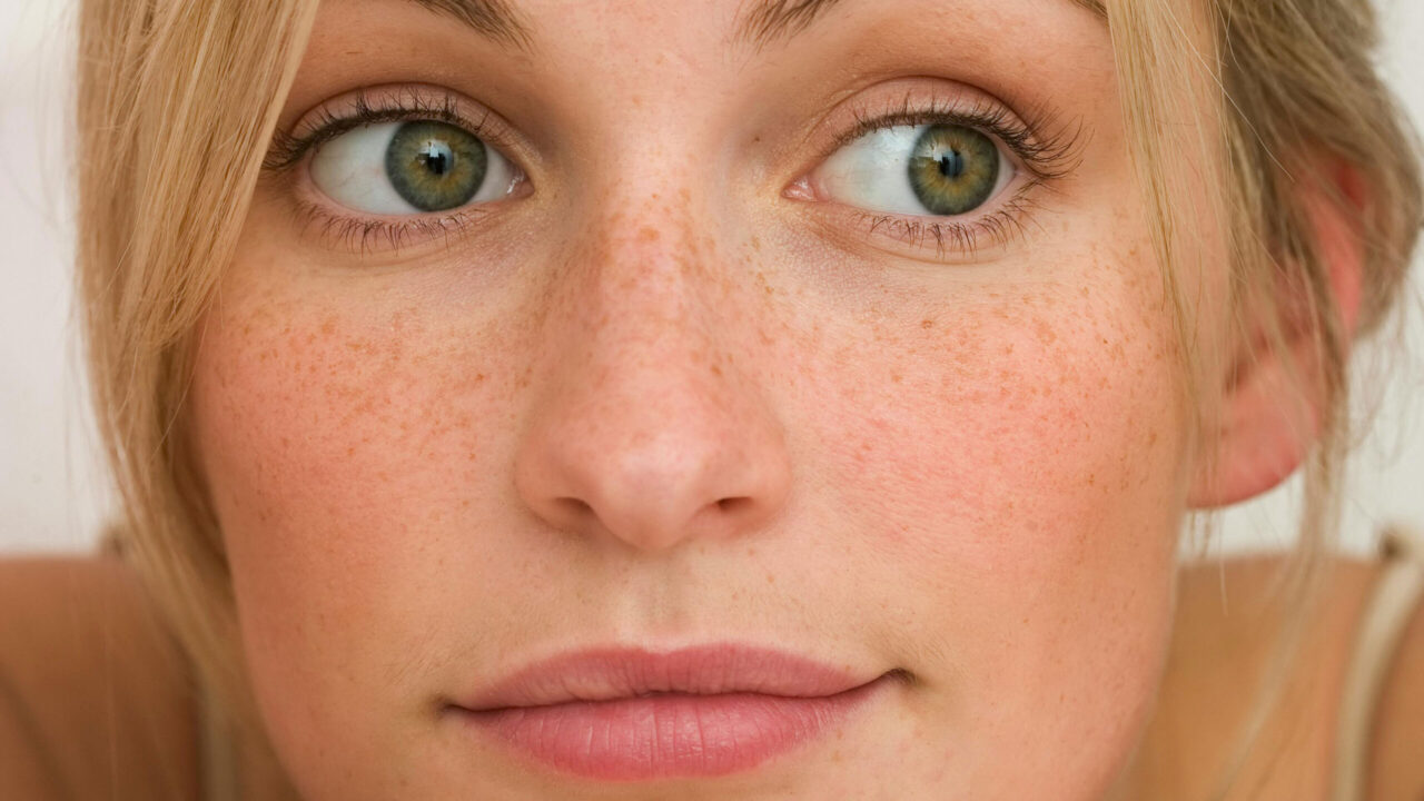 Von ersten Symptomen bis zur Laserbehandlung erklärt dieser Beitrag auf sonrisa alles was man über Rosazea wissen muss.