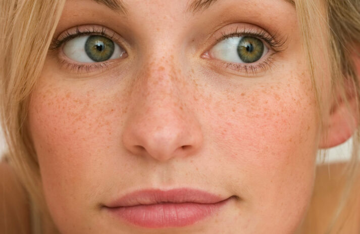 Von ersten Symptomen bis zur Laserbehandlung erklärt dieser Beitrag auf sonrisa alles was man über Rosazea wissen muss.